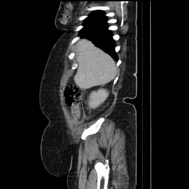 Acute pyelonephritis (Radiopaedia 25657-25837 Sagittal renal parenchymal phase 20).jpg