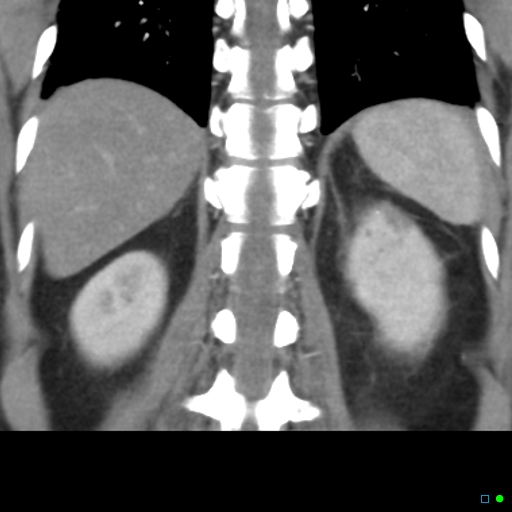 File:Acute pyelonephritis and emphysematous pyonephrosis (Radiopaedia 27893-28128 Coronal renal cortical phase 16).jpg