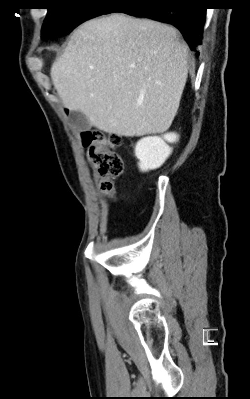 Acute renal infarction (Radiopaedia 59375-66736 Sagittal C+ portal venous phase 48).jpg