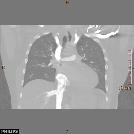 File:Acute reversible pulmonary hypertension and right heart failure from cocaine toxicity (Radiopaedia 49394-54517 Coronal C+ CTPA 21).jpg