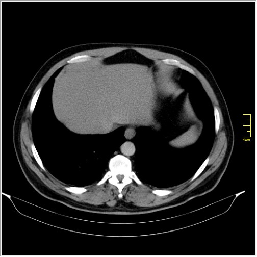 Acute right sided diverticulitis (Radiopaedia 65249-74268 Axial C+ portal venous phase 7).JPG