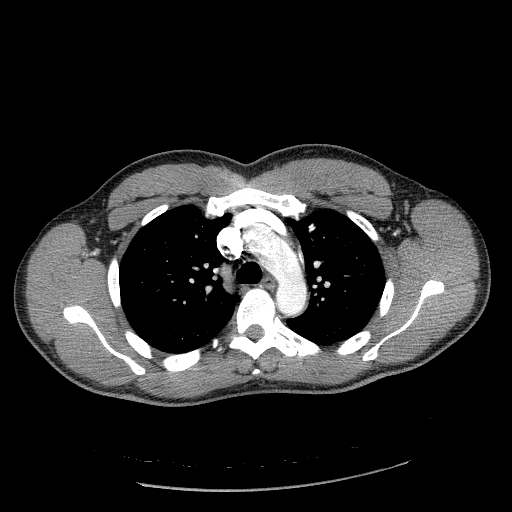 File:Acute segmental pulmonary emboli and pulmonary infarction (Radiopaedia 62264-70444 Axial C+ CTPA 38).jpg