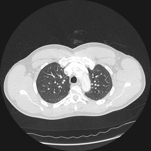 Acute segmental pulmonary emboli and pulmonary infarction (Radiopaedia 62264-70444 Axial lung window 47).jpg