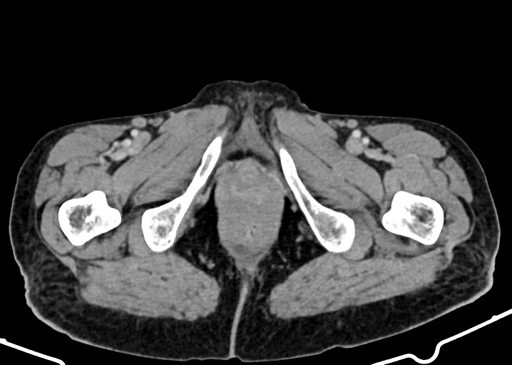Acute small bowel (ileal) volvulus (Radiopaedia 71740-82139 Axial C+ portal venous phase 211).jpg