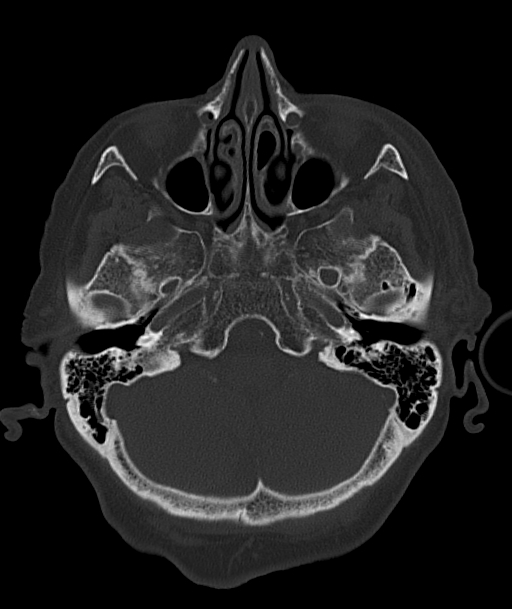 Acute traumatic subdural hematoma (Radiopaedia 82921-97257 Axial bone window 85).jpg