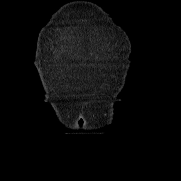 Acute tubular necrosis (Radiopaedia 28077-28334 G 7).jpg