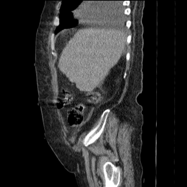 Acute tubular necrosis (Radiopaedia 28077-28334 Sagittal non-contrast 20).jpg