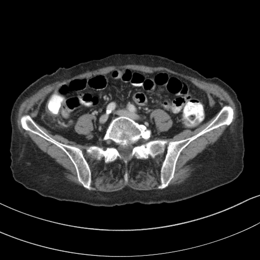 Adenocarcinoma of cecum (Radiopaedia 59222-66549 Axial C+ portal venous phase 103).jpg