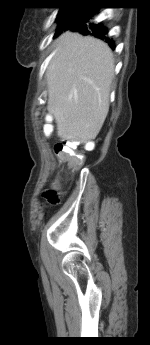 Adenocarcinoma of cecum (Radiopaedia 59222-66549 Sagittal C+ portal venous phase 86).jpg