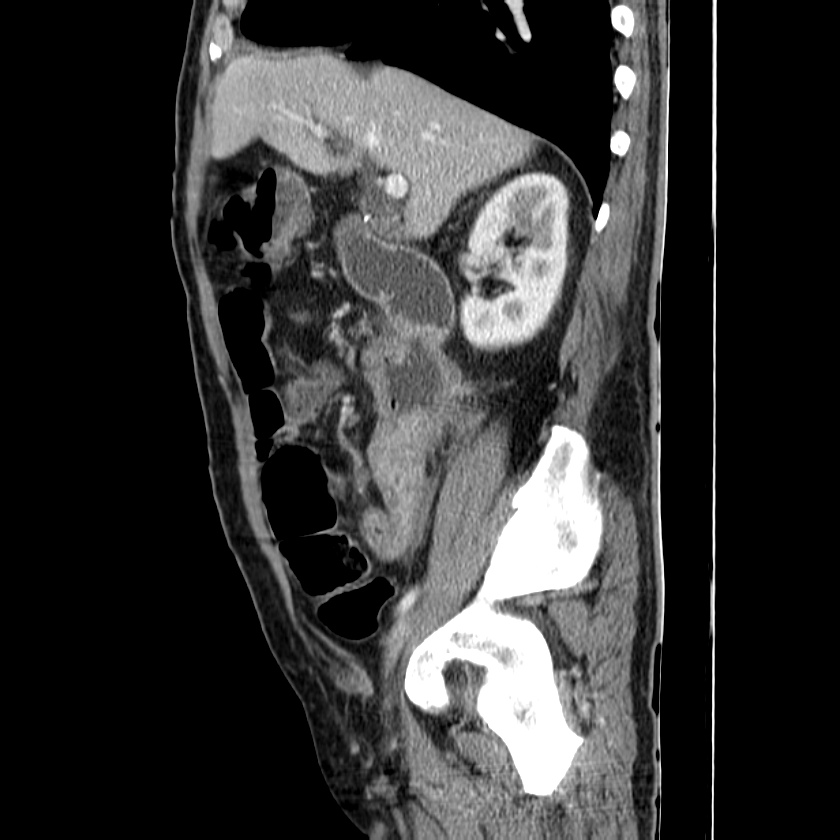 Adenocarcinoma of colon with entero-colic fistula (Radiopaedia 22832-22852 Sagittal C+ portal venous phase 22).jpg