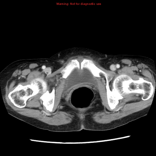 File:Adenocarcinoma of the colon (Radiopaedia 8191-9039 Axial liver window 74).jpg