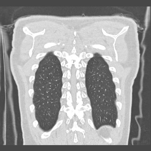 Adenocarcinoma of the lung (Radiopaedia 59871-67325 Coronal lung window 59).jpg