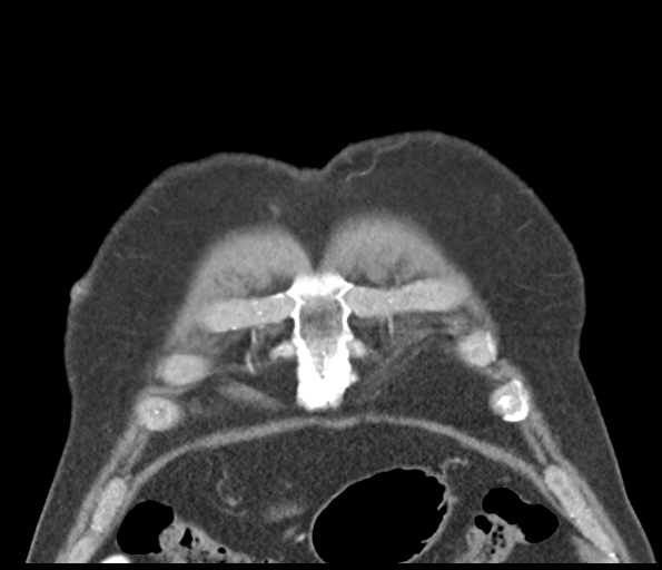 Adenocarcioma of rectum- T1 lesion (Radiopaedia 36921-38547 Coronal C+ arterial phase 11).png