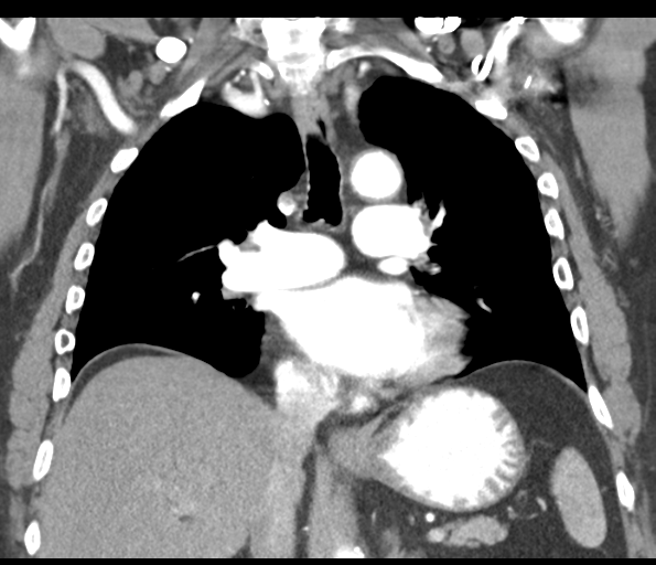 File:Adenocarcioma of rectum- T1 lesion (Radiopaedia 36921-38547 Coronal C+ arterial phase 34).png