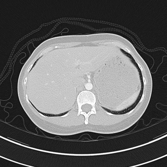 File:Adenocystic carcinoma of the trachea (Radiopaedia 47677-52525 Axial lung window 76).jpg