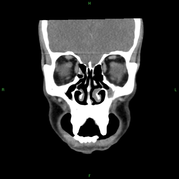 File:Adenoid cystic carcinoma of hard palate (Radiopaedia 26137-26273 Coronal liver window 6).jpg