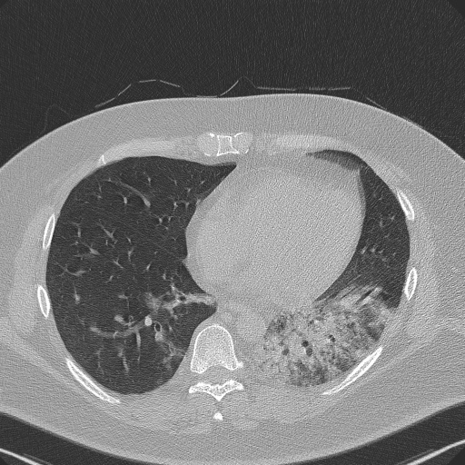 Adenoid cystic carcinoma of the trachea (Radiopaedia 49042-54137 Axial lung window 233).jpg