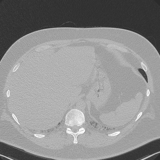 Adenoid cystic carcinoma of the trachea (Radiopaedia 49042-54137 Axial lung window 312).jpg
