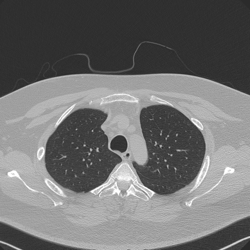 Adenoid cystic carcinoma of the trachea (Radiopaedia 49042-54137 Axial lung window 84).jpg