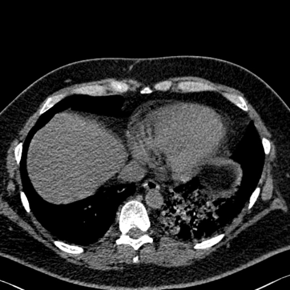 Adenoid cystic carcinoma of the trachea (Radiopaedia 49042-54137 Axial non-contrast 267).jpg