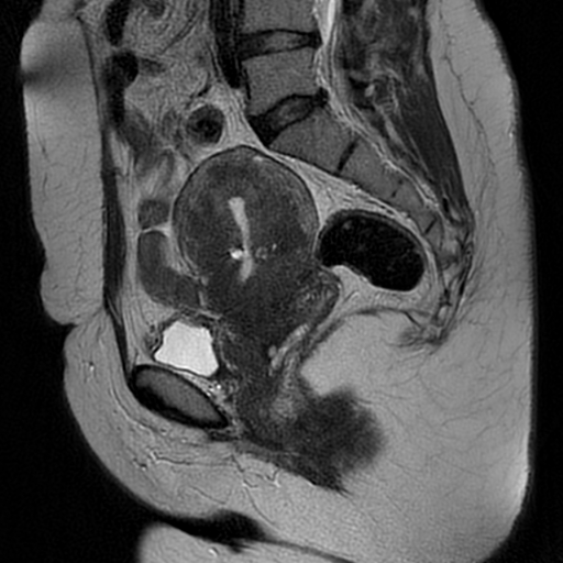 File:Adenomyosis-scar endometriosis (Radiopaedia 65863-75022 Sagittal T2 15).jpg