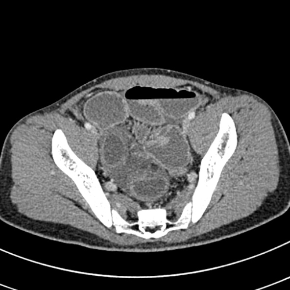 Adhesional small bowel obstruction (Radiopaedia 52107-57980 Axial C+ portal venous phase 107).jpg