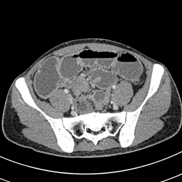 Adhesional small bowel obstruction (Radiopaedia 52107-57980 Axial C+ portal venous phase 96).jpg