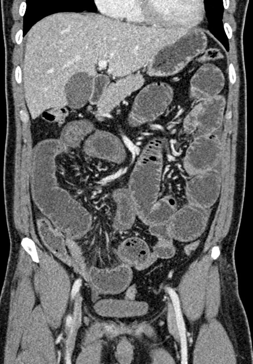 Adhesional small bowel obstruction (Radiopaedia 58900-66131 Coronal C+ portal venous phase 115).jpg