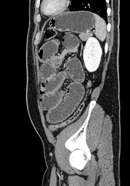 Adhesional small bowel obstruction (Radiopaedia 58900-66131 Sagittal C+ portal venous phase 195).jpg