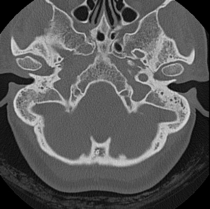 File:Adhesive chronic otitis media (Radiopaedia 14270-14148 Axial bone window 17).jpg