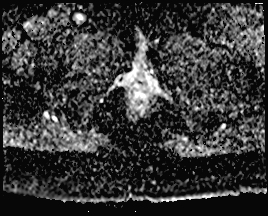 File:Adnexal multilocular cyst (O-RADS US 3. O-RADS MRI 3) (Radiopaedia 87426-103754 Axial 176).jpeg