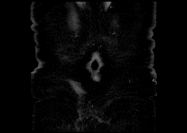 File:Adrenal cortical carcinoma (Radiopaedia 64017-72769 Coronal C+ portal venous phase 56).jpg