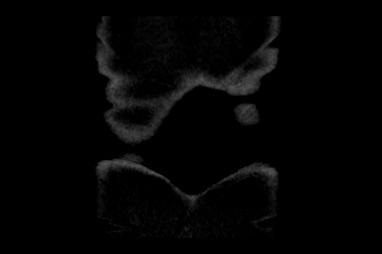 Adrenal cortical carcinoma (Radiopaedia 64017-72769 Coronal non-contrast 61).jpg