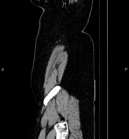 Adrenal cortical carcinoma (Radiopaedia 84882-100379 Sagittal C+ portal venous phase 3).jpg