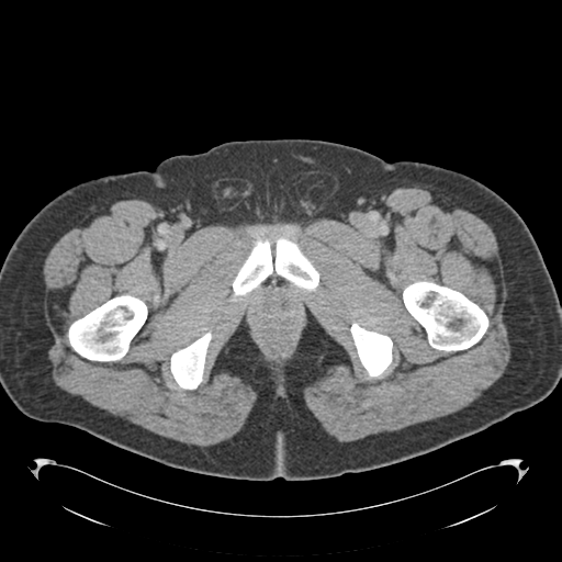 Adrenal cyst (Radiopaedia 45625-49776 Axial C+ portal venous phase 102).png