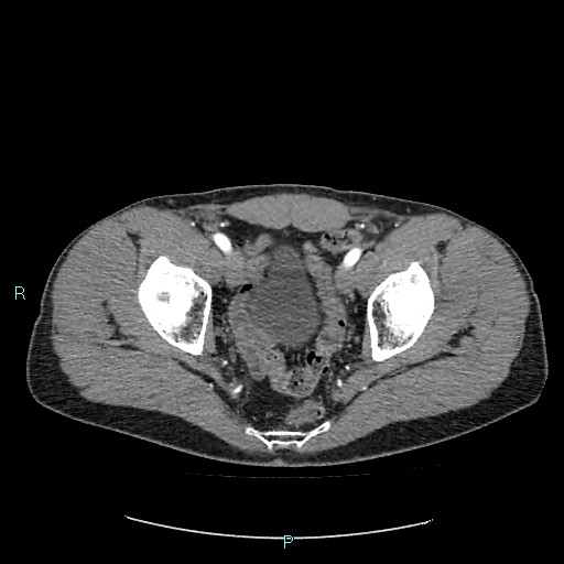 Adrenal cystic lymphangioma (Radiopaedia 83161-97534 Axial C+ arterial phase 88).jpg