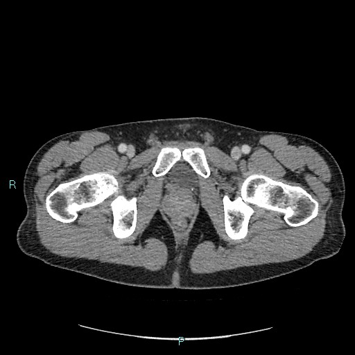 Adrenal cystic lymphangioma (Radiopaedia 83161-97534 Axial C+ portal venous phase 100).jpg