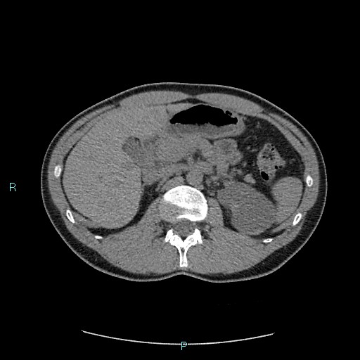 File:Adrenal cystic lymphangioma (Radiopaedia 83161-97534 Axial non-contrast 33).jpg