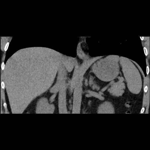 File:Adrenal gland trauma (Radiopaedia 81351-95079 Coronal non-contrast 50).jpg
