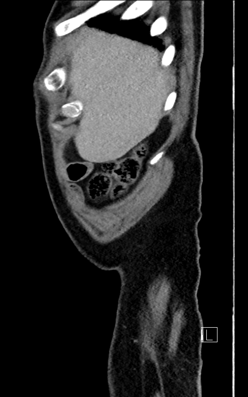Adrenal lymphoma (Radiopaedia 73730-84529 Sagittal C+ portal venous phase 8).jpg