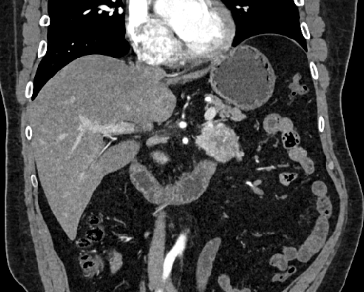 File:Adrenal metastases (Radiopaedia 73082-83791 Coronal C+ arterial phase 12).jpg