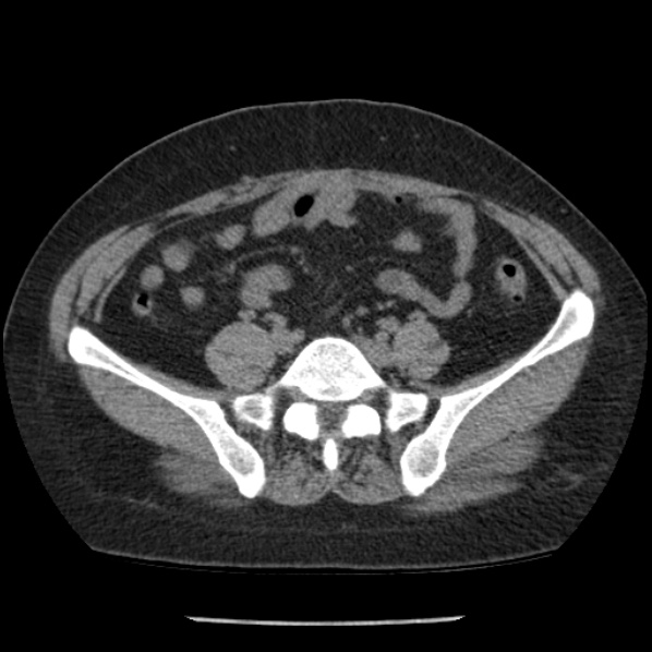 Adrenal myelolipoma (Radiopaedia 43401-46759 Axial non-contrast 61).jpg
