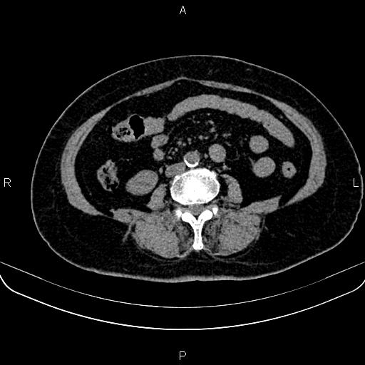 Adrenal myelolipoma (Radiopaedia 82742-96986 Axial non-contrast 93).jpg