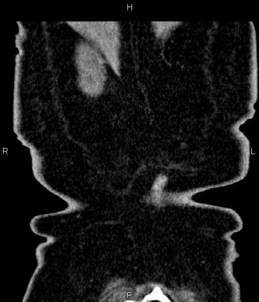 Adrenal myelolipoma (Radiopaedia 82742-96986 Coronal renal cortical phase 75).jpg