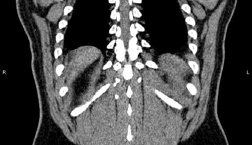 Adrenal myelolipoma (Radiopaedia 84321-99619 Coronal non-contrast 68).jpg