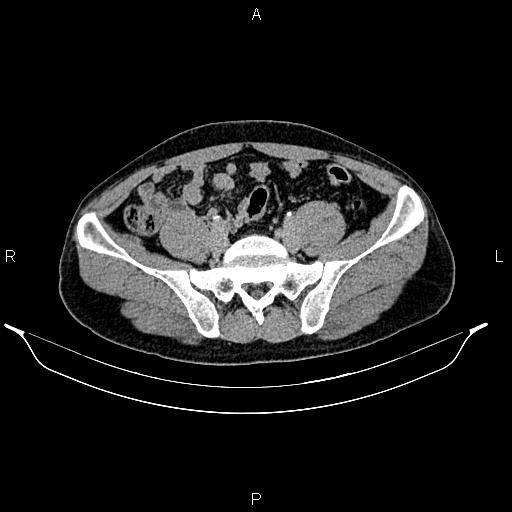 Adrenal myelolipoma (Radiopaedia 87794-104246 Axial renal excretory phase 75).jpg