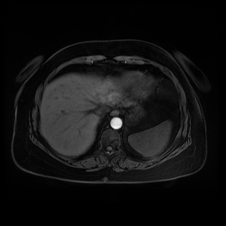 Adrenal myelolipoma - MRI (Radiopaedia 83249-97646 Axial T1 fat sat 4).jpg