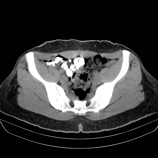 File:Adrenal myelolipoma - bilateral (Radiopaedia 74805-85810 Axial non-contrast 65).jpg