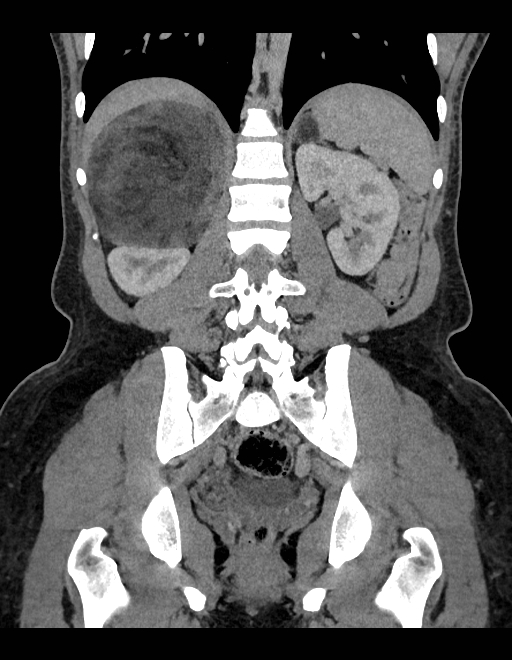 Adrenal myelolipoma - bilateral (Radiopaedia 74805-85810 Coronal C+ portal venous phase 113).jpg