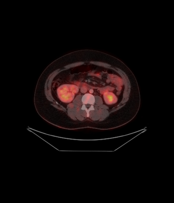Adrenocortical carcinoma (Radiopaedia 80134-93440 ِAxial 186).jpg